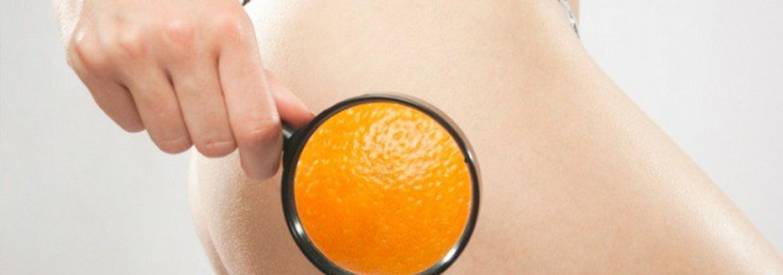 Целлюлит. Как избавиться от «синдрома апельсиновой корки»?