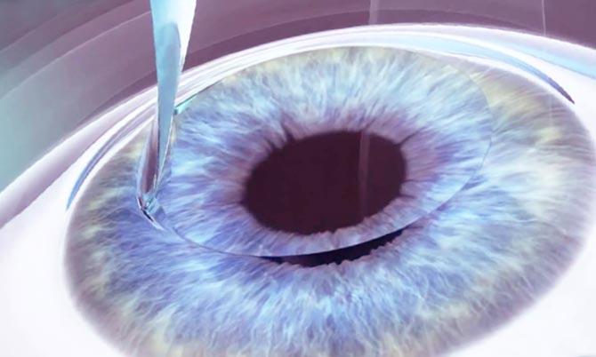 кератопластика глаз