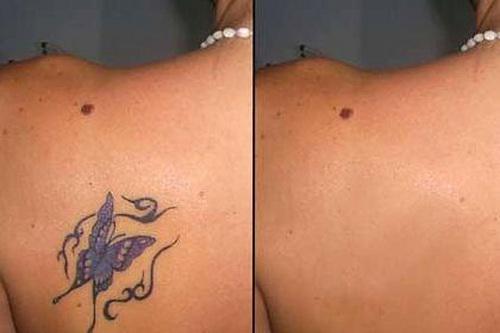 лазерное удаление тату до и после фото