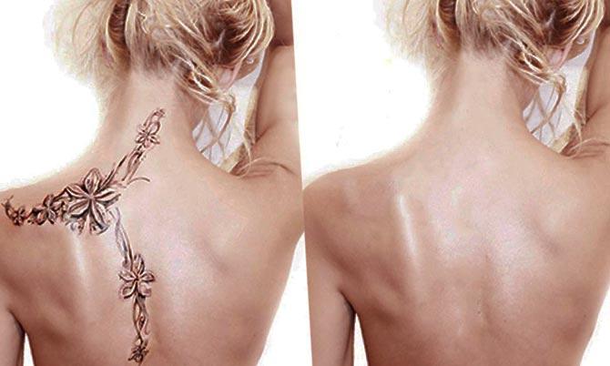 Удаление татуировки. Фото до и после. Как удалить татуировку? - KRASOTA.ru