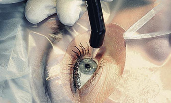 При удалении катаракты лазером не нарушается целостность тканей глаза