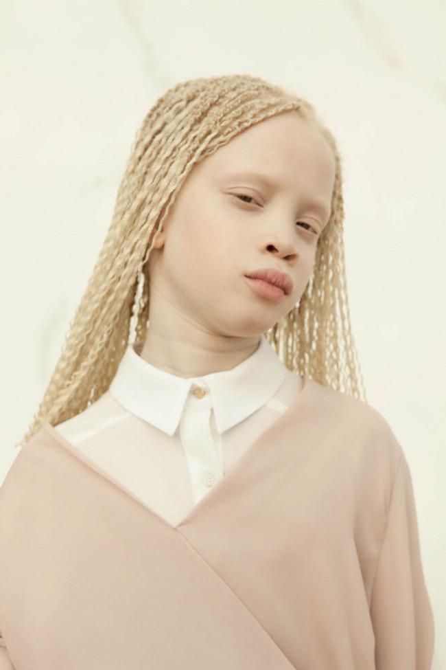 негритянка-альбинос