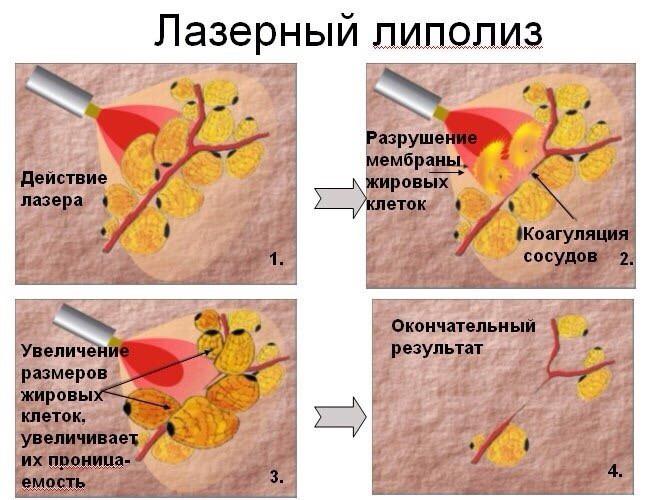 особенности процедуры лазерного липолиза